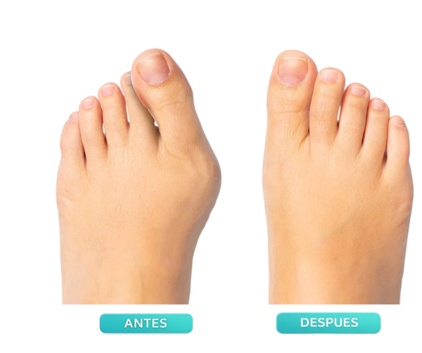 PieVida™ | Corrector Ajustable para Juanetes